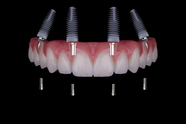 Benefits Of All On   Implants