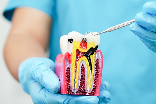 How Root Canals Save Your Natural Tooth